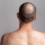 singapore fut hair transplant