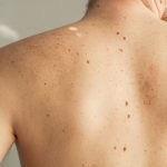 MOHS Micrographic Surgery, Skin Cancer Treatment