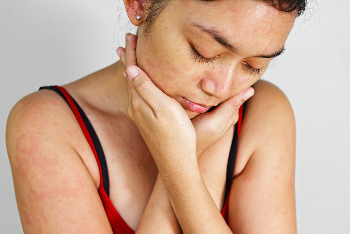 Dermatology Specialists Singapore, Angeline Yong Dermatology