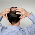 FUT Hair Transplant, FUE Hair Transplant