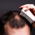 Hair Transplant Surgery Clinic, FUE Hair Transplant