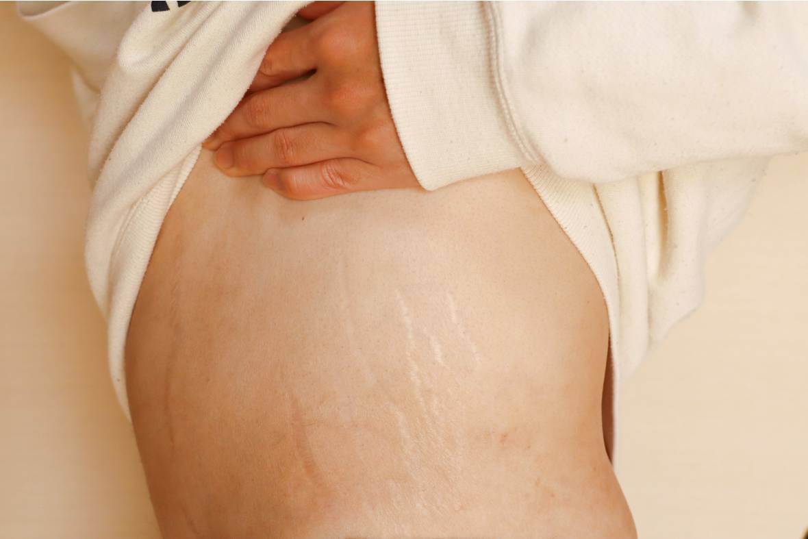 Pico Laser, Pico Laser Singapore