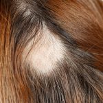 Hair Transplant Clinic, Hair Transplant Clinic Singapore