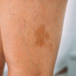 Skin Dermatologist Singapore, Dermatology Clinic Singapore