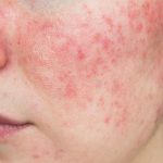 Investigating Rosacea: Treatments To Overcome The Redness